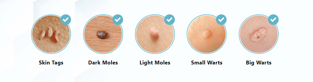 Deor Skin Tag Remover Work